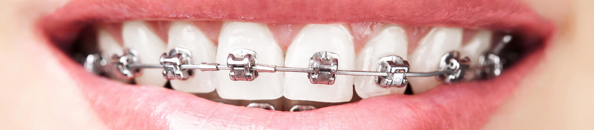 aparaty stałe ortodontyczne